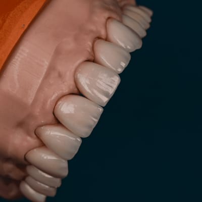 Dinți artificiali cu fațete ceramice albe pe fundal albastru.