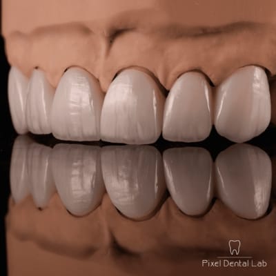 Fatete dentare ceramice premium, albe, cu detalii striate.