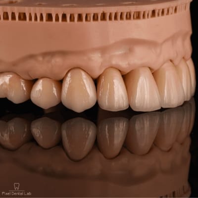 Model de dentiție cu fațete ceramice și culoare naturală.