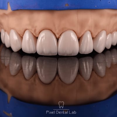 Dentură ceramică albă, lucioasă, pe gingie artificială, albastră.