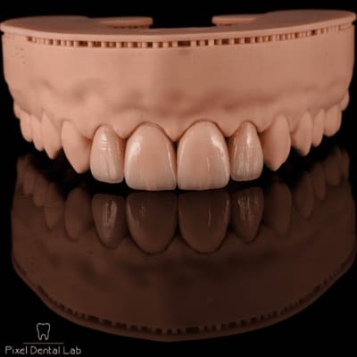Fatete dentare ceramice, realistic model, culoare naturală, Pixel Dental Lab.