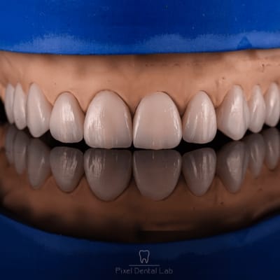 Fațete ceramice pe model gingival, reflectate pe suprafață lucioasă.