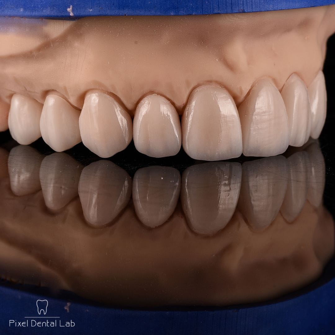 Fațete dentare ceramice, culoare albă, realist aranjate pe mulaj.