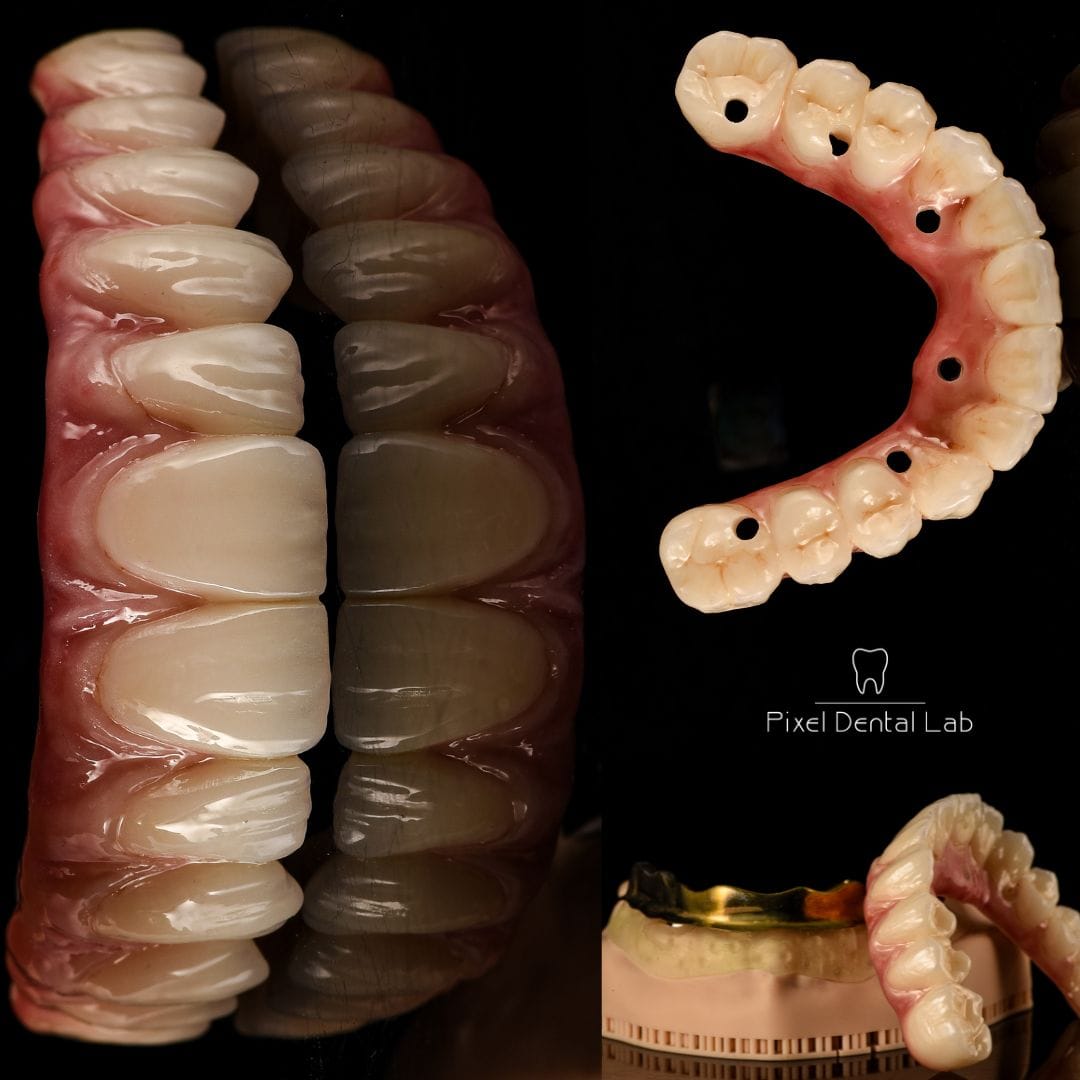 Fatete ceramice albe, proteza parțială, text: Pixel Dental Lab.