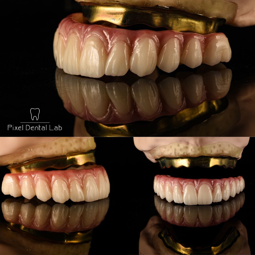 Proteze dentare premium cu structură metalică, dinți culoare naturală.
