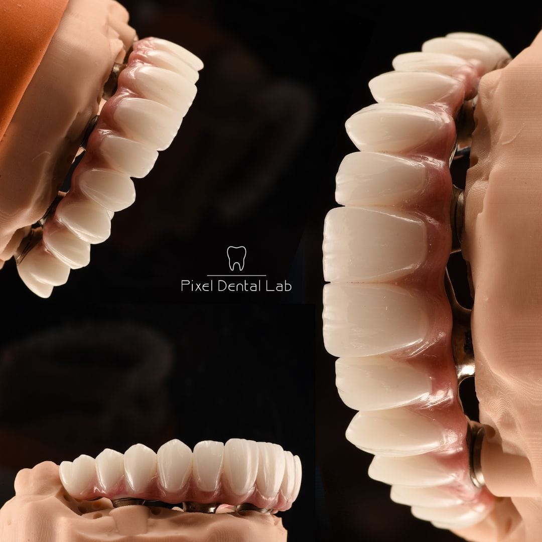 Coroane dentare albe pe suporturi metalice pe gingii artificiale.