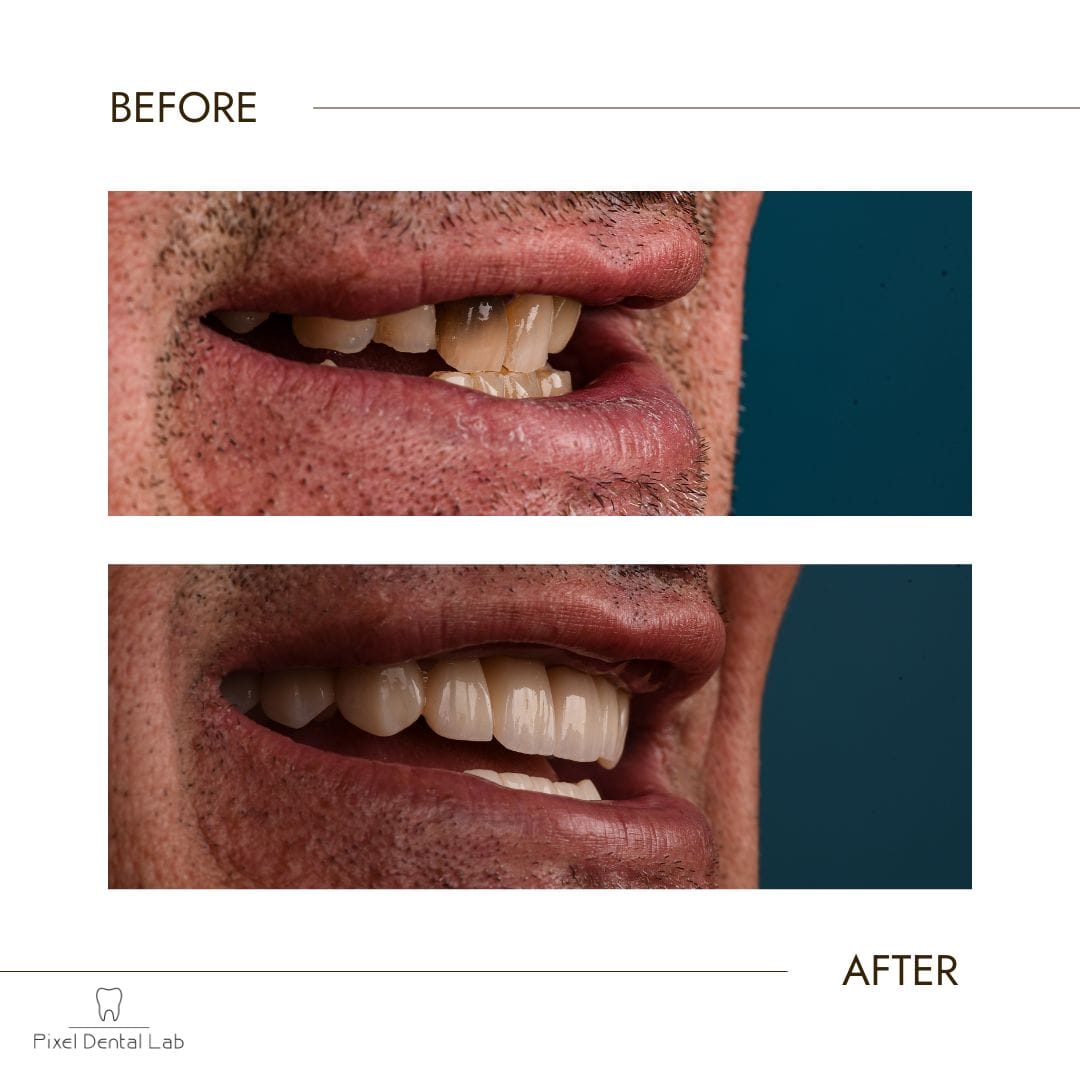 Dinții înainte și după, diferență vizibilă în culoare și aliniere.