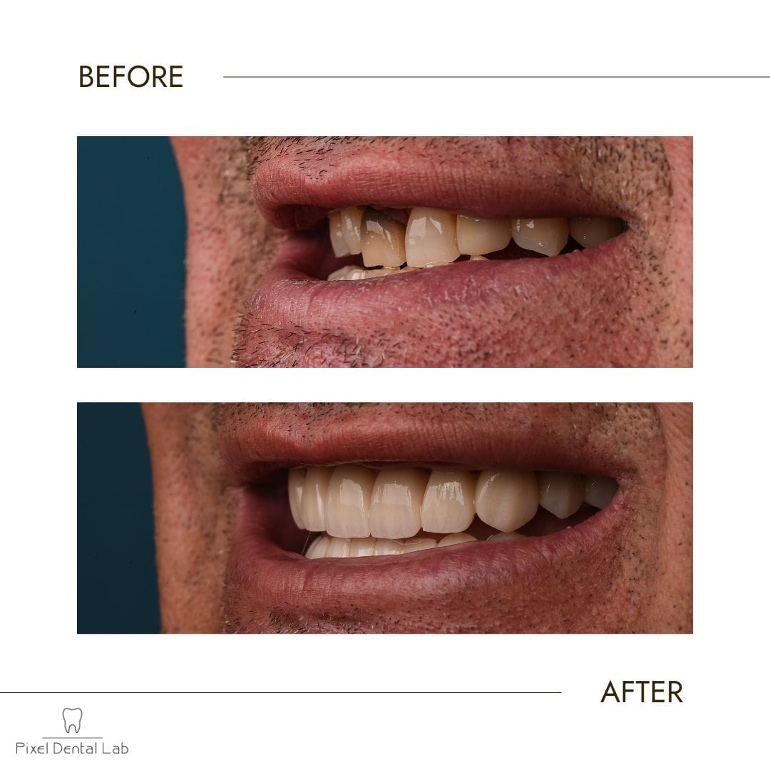 Dinte înainte cu defecte, după cu fațete ceramice luminoase.