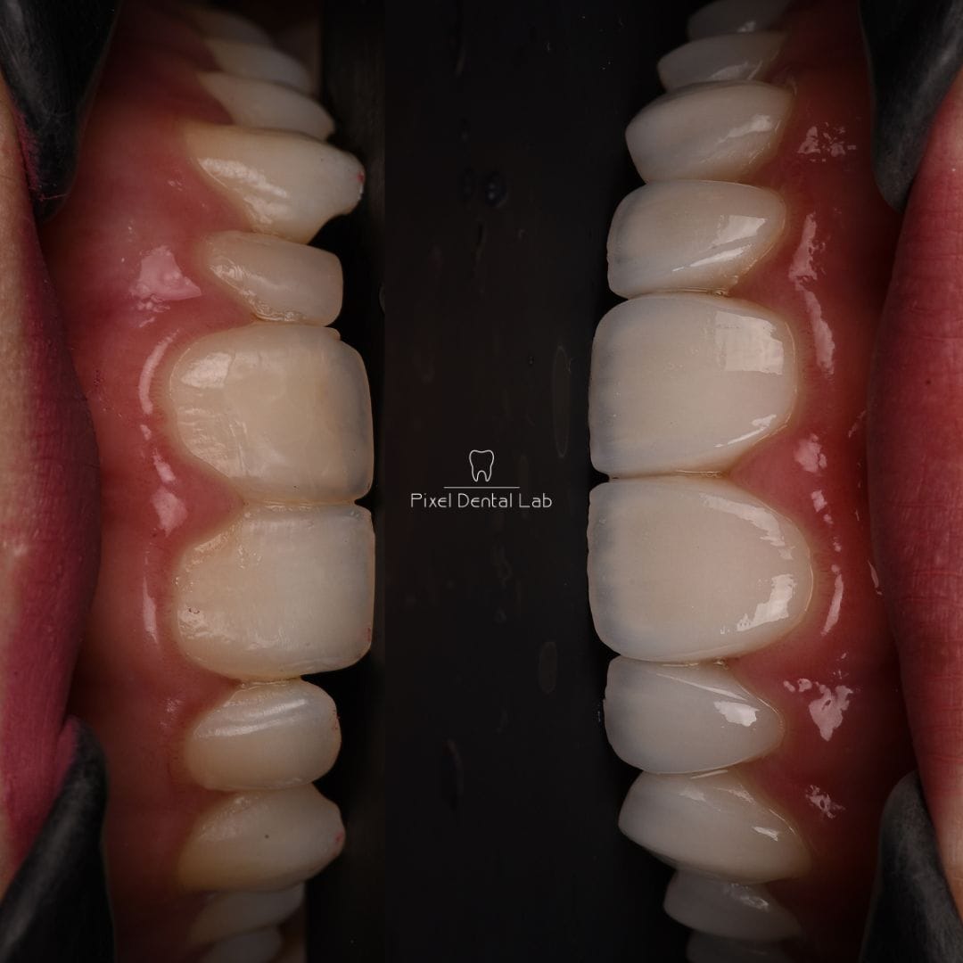 Doi dinți cu fațete dentare ceramice, culoare albă.