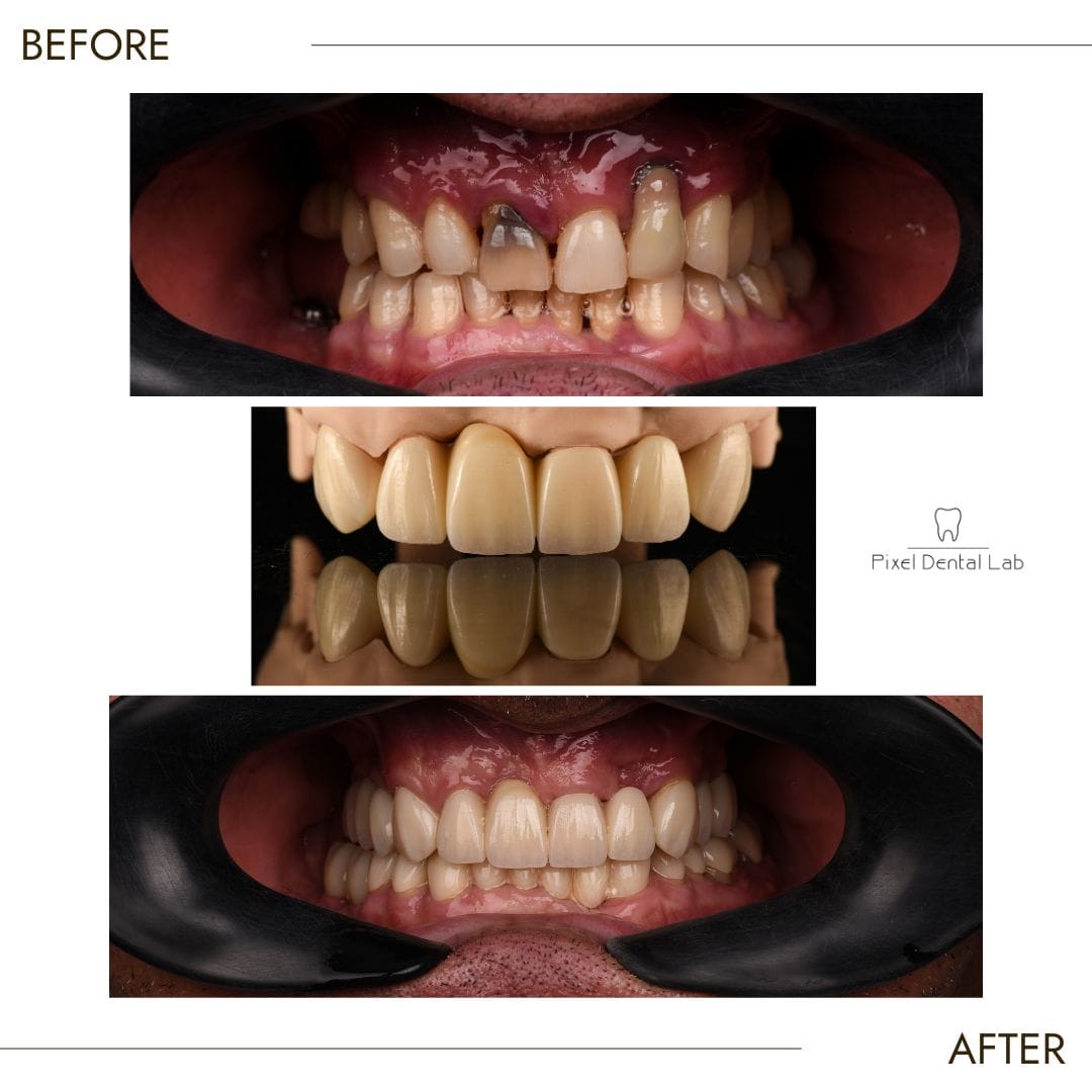 Dentiție înainte și după lucrări: coroane dentare albe uniforme.