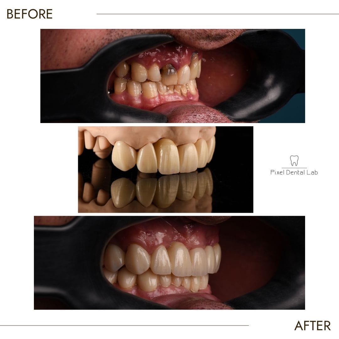 Dinți inițial deteriorați, apoi fatete dentare ceramice aplicate.