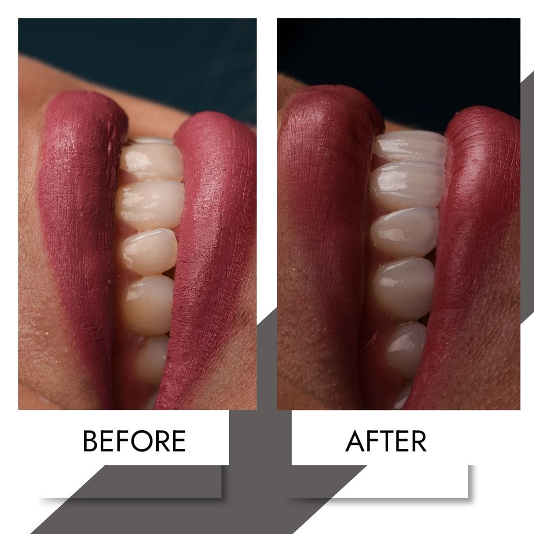 Imagine înainte și după aplicarea fațetelor dentare ceramice.