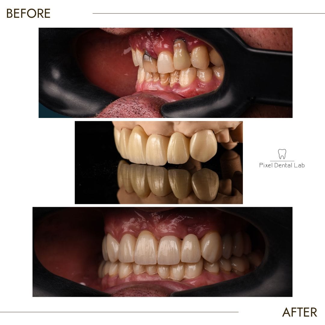 Dinti înainte și după tratament, cu schimbare estetică vizibilă.