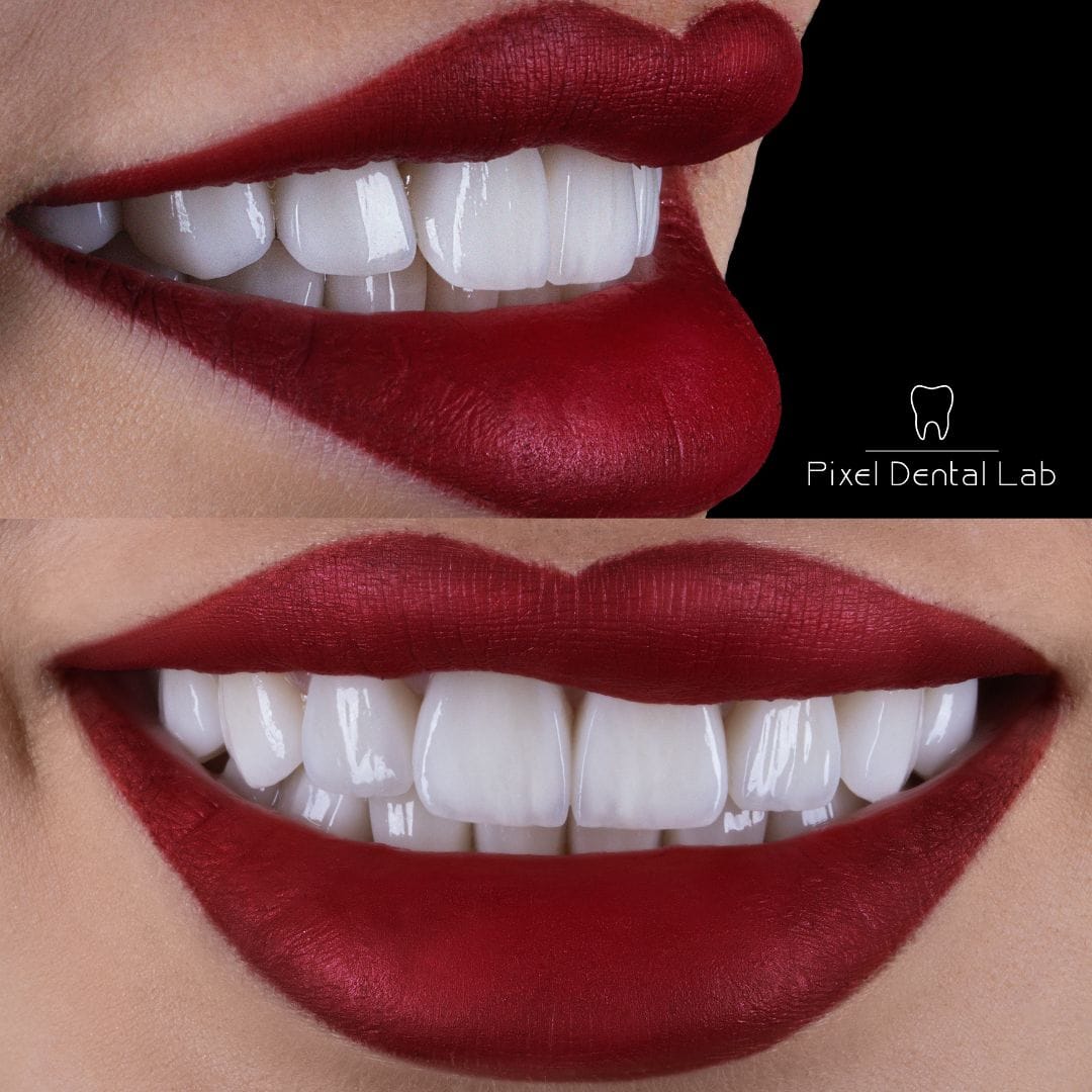 Fațete dentare ceramice albe, buze roșii, text: Pixel Dental Lab.
