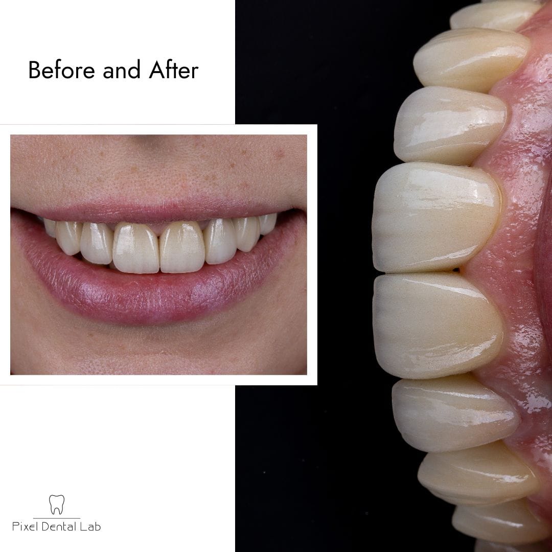 Zâmbet cu fațete dentare ceramice, alb, lucios, detaliu dinți. Text: Before and After.