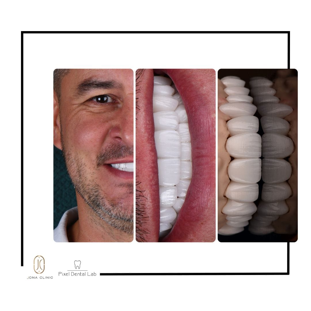 Chip zâmbitor, dinți albi perfecți și modele dentare 3D.