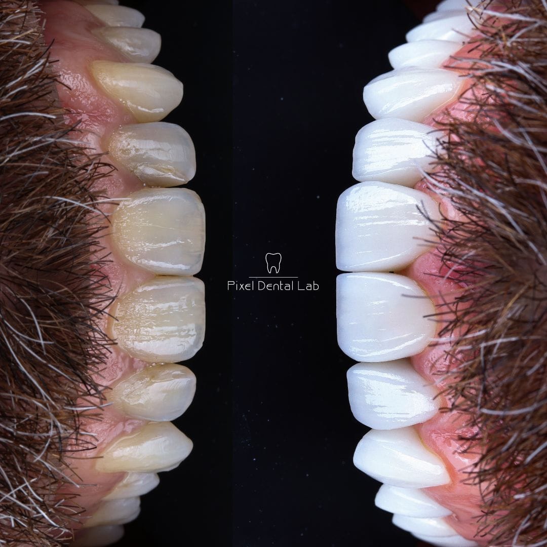 Dinti înainte și după fatete dentare ceramice albe, lucioase.