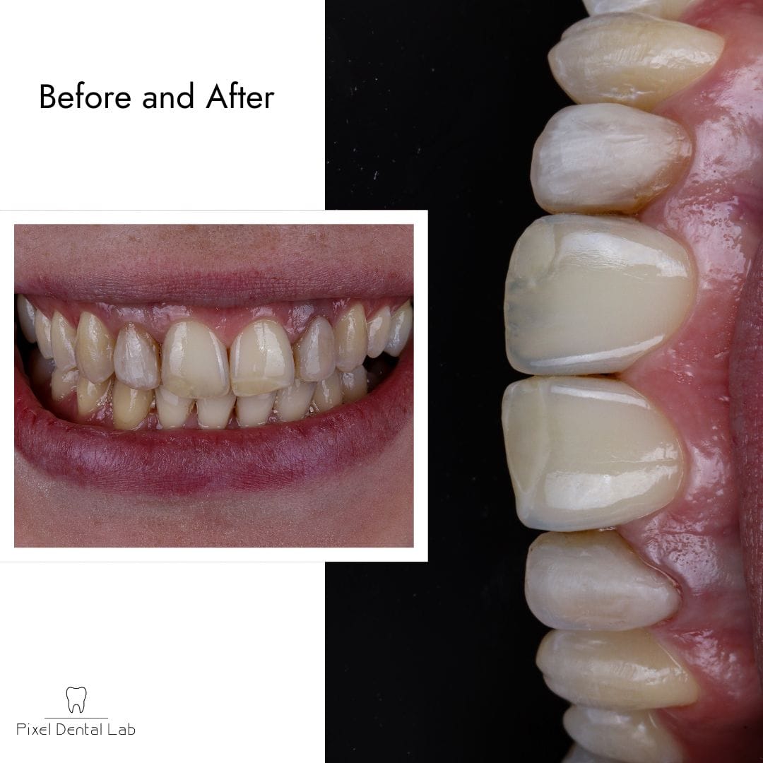 Dinte cu fațetă ceramică, culoare albă, înainte și după.