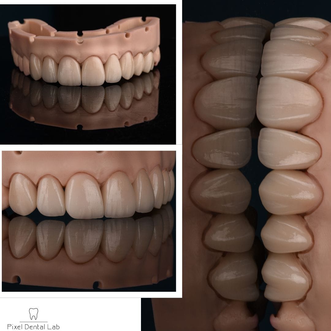 Coroane dentare ceramice albe, fațete dentare lucioase. Pixel Dental Lab.