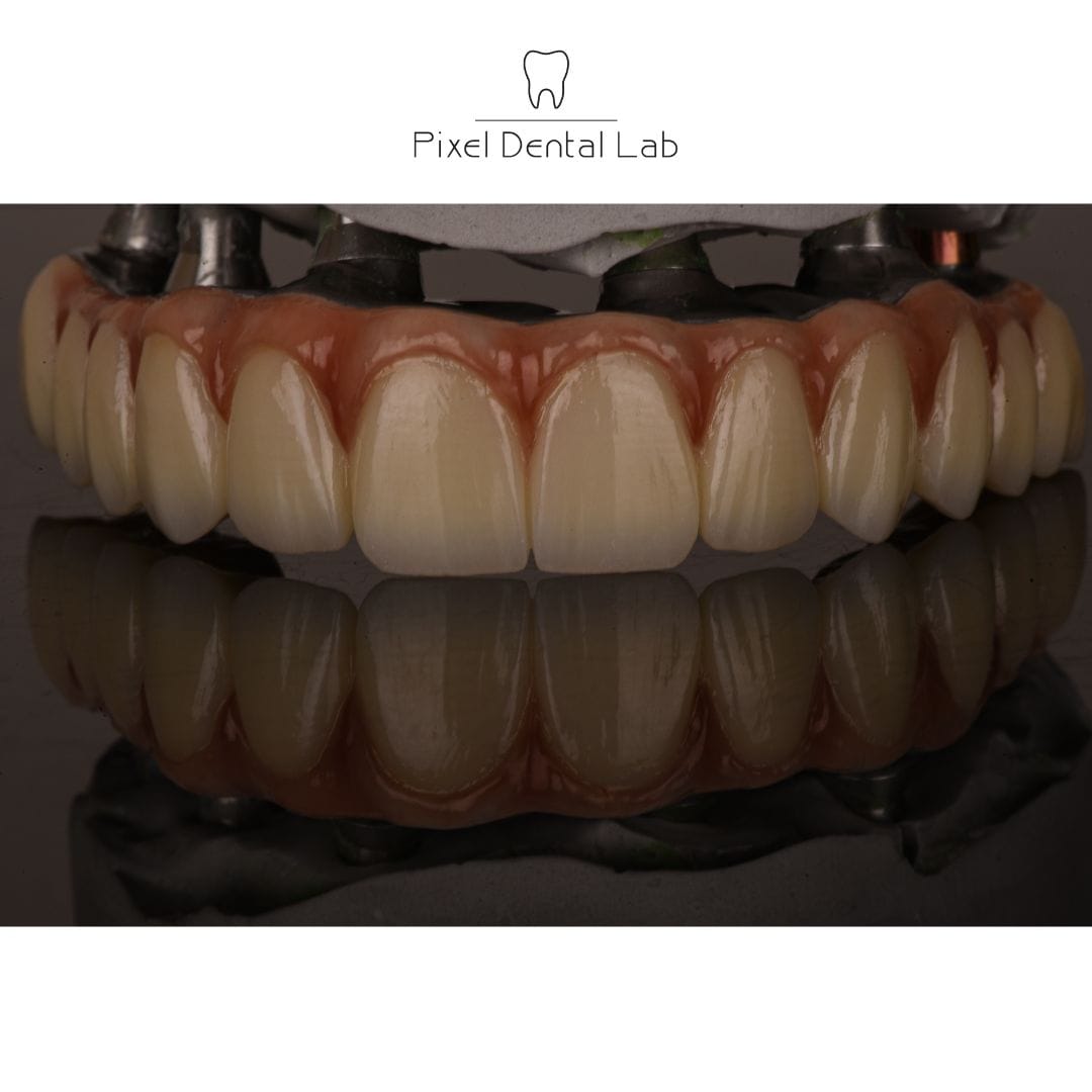 Coroane dentare ceramice, culoare naturală, pe suport metalic.