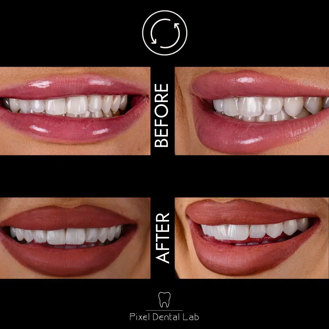 Arhive Feldspathic and Refractory Veneers - Pixel Dent