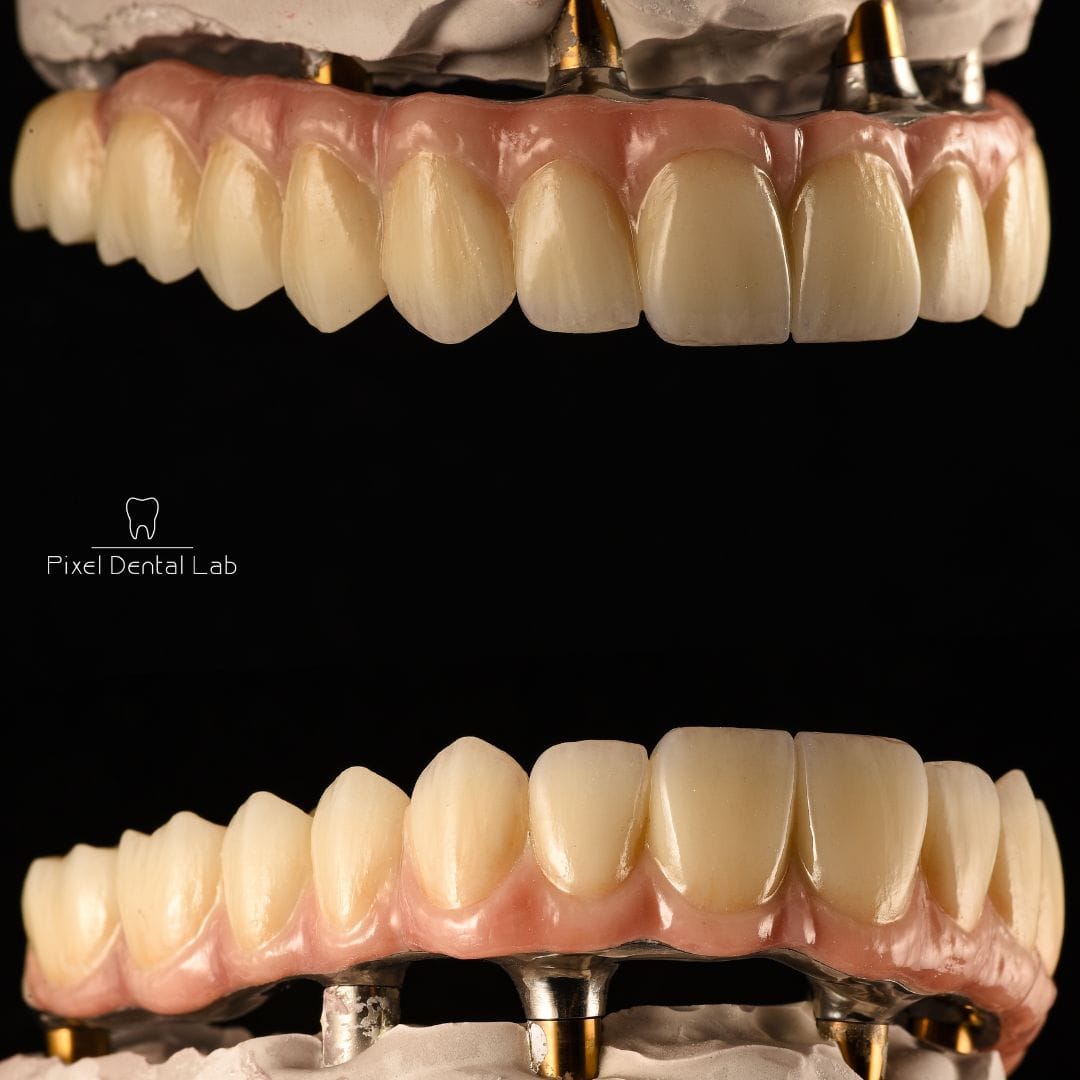 Dentiție cu proteze pe implanturi, aspect natural, nuanță alb-ivoire.