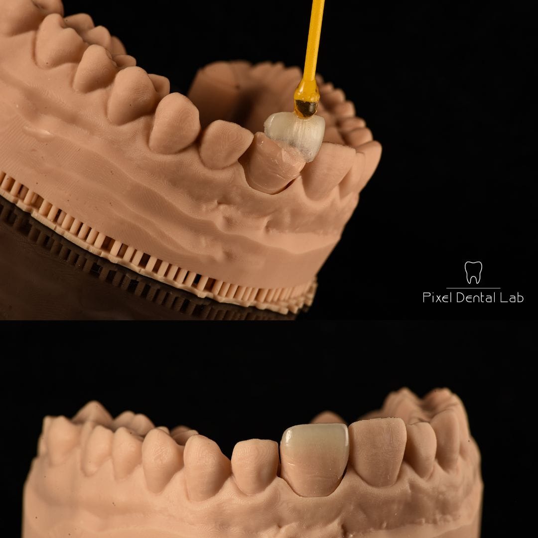 Model dentar, aplicare coroană ceramică cu instrument galben.