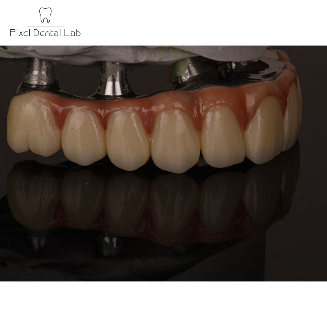 Coroane dentare premium pe implanturi, culoare naturală, detalii precise.