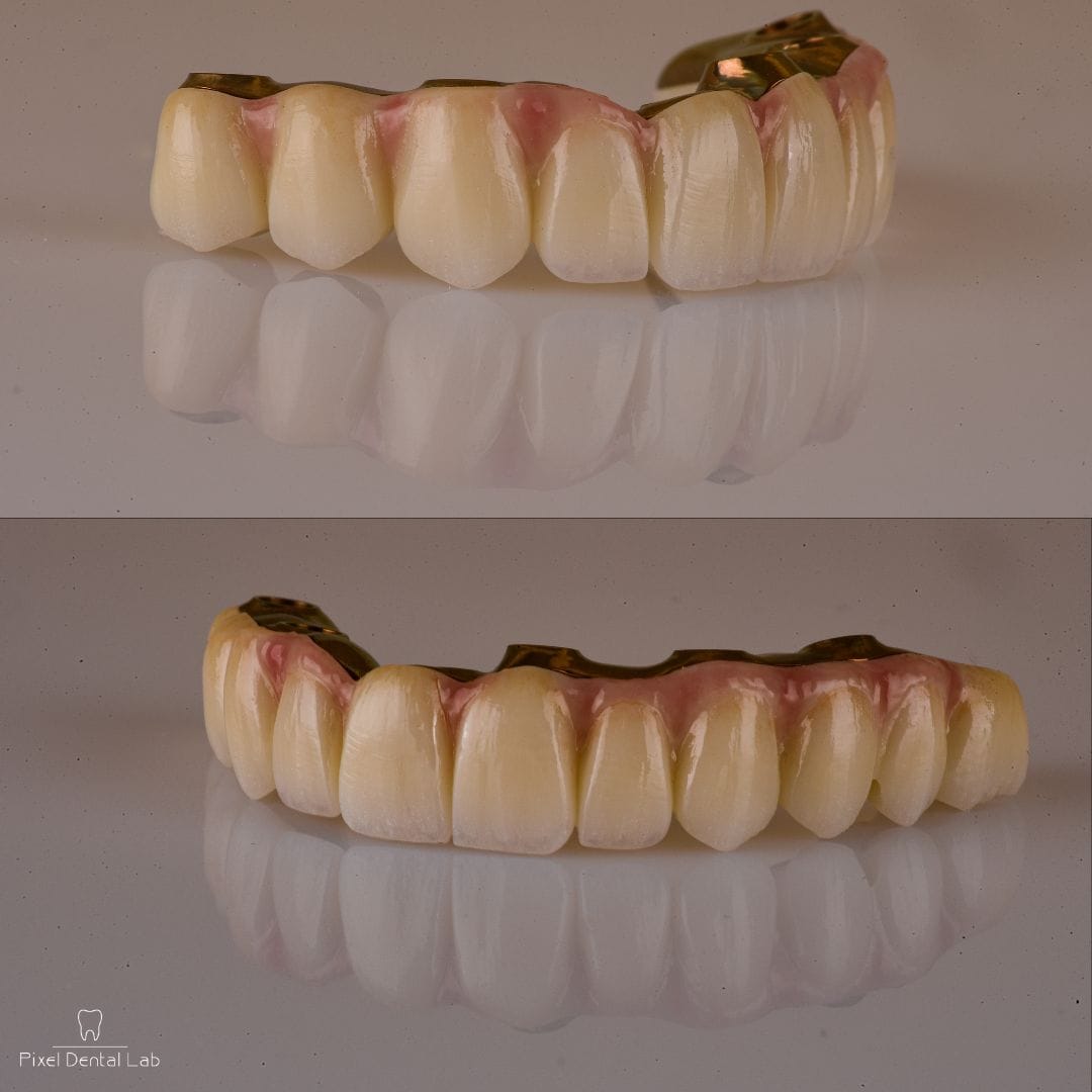 Fatete dentare ceramice, aspect natural, nuanță alb-ivoriu, detalii roz.