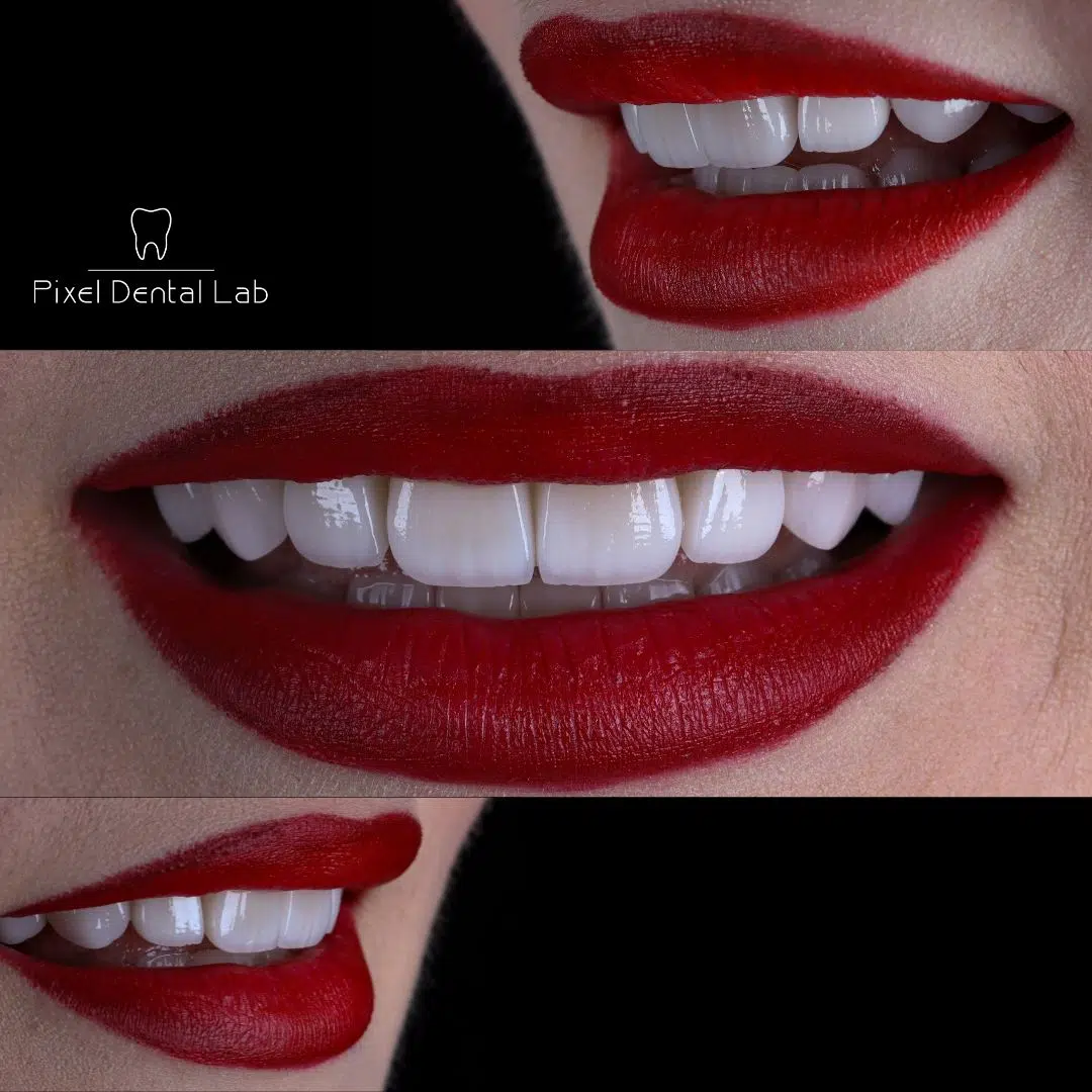Fatete dentare premium - Fatete Feldspatice sau Refractare
