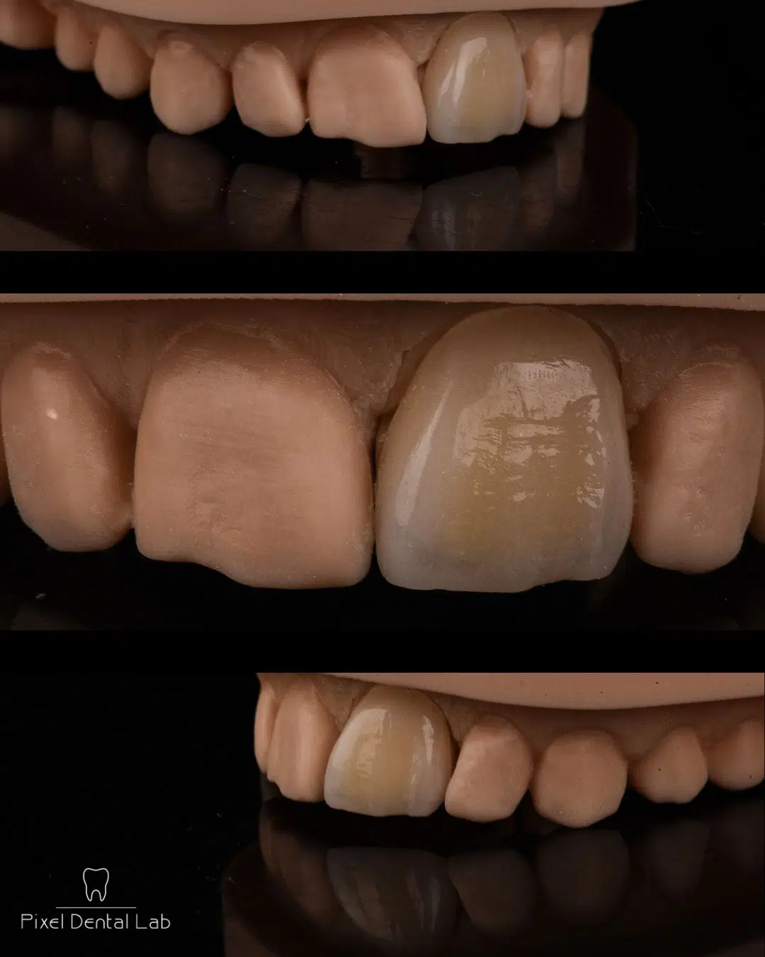 Arhive Feldspathic and Refractory Veneers - Pixel Dent